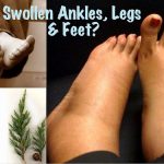 Essential Oil Treatments For Swollen Ankles, Legs and Feet