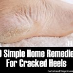 Top 10 Simple Home Remedies For Cracked Heels