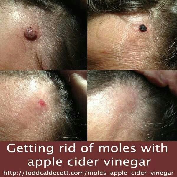 How To Get Rid Of Moles With Apple Cider Vinegar