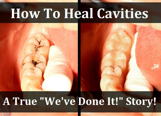 How To Heal Cavities