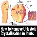 How To Remove Uric Acid Crystallization In Joints