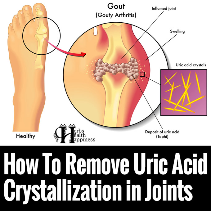 How To Remove Uric Acid Crystallization in Joints