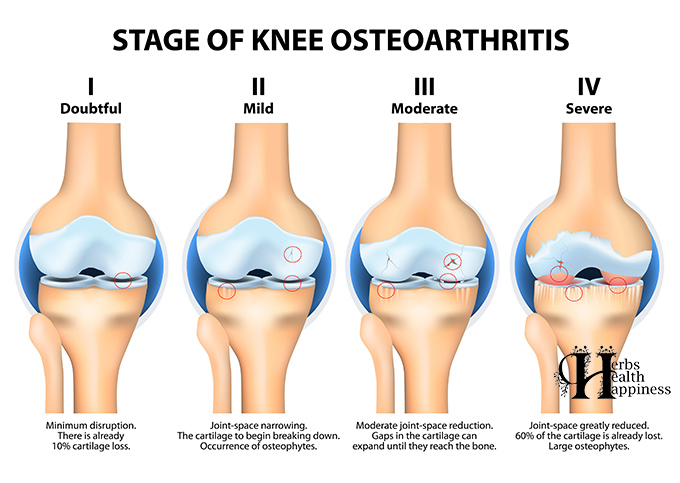 Stages Of Knee Osteoarthritis