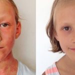 How A Mother Naturally Cured Her Daughter’s Eczema
