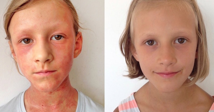 How A Mother Naturally Cured Her Daughter's Eczema