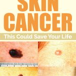 How To Recognize Skin Cancer – This Could Save Your Life