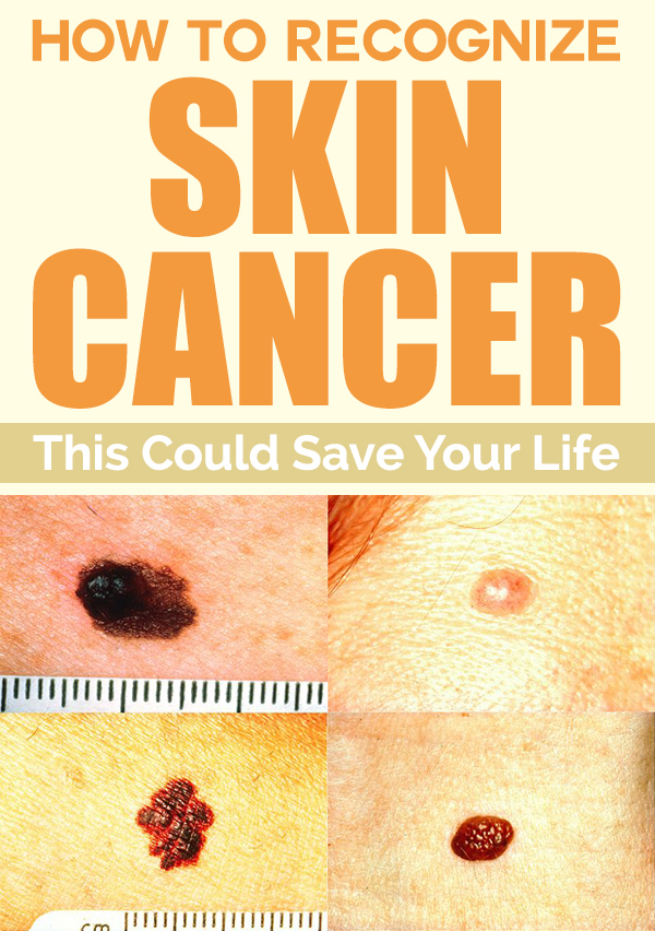 How To Recognize Skin Cancer - This Could Save Your Life