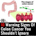 10 Warning Signs Of Colon Cancer You Shouldn’t Ignore