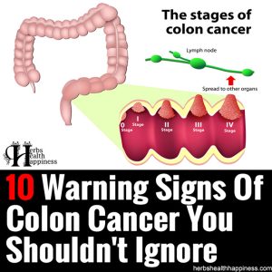 10 Warning Signs Of Colon Cancer You Shouldn’t Ignore - Herbs Health ...