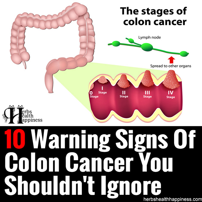 10 Warning Signs Of Colon Cancer You Shouldnt Ignore