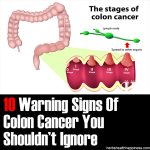 10 Warning Signs Of Colon Cancer You Shouldn’t Ignore