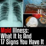 Mold Illness: What It Is And 17 Signs You Have It