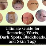 The Ultimate Guide To Naturally Removing Warts, Dark Spots, Blackheads, And Skin Tags