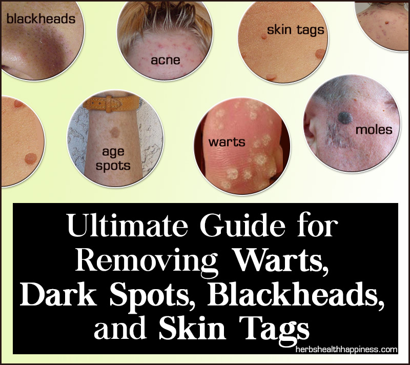The Ultimate Guide To Naturally Removing Warts, Dark Spots, Blackheads, And Skin Tags