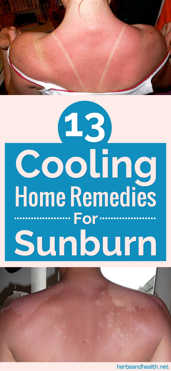 13 Cooling Home Remedies For Sunburn