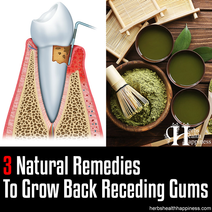 3 Natural Remedies To Grow Back Receding Gums