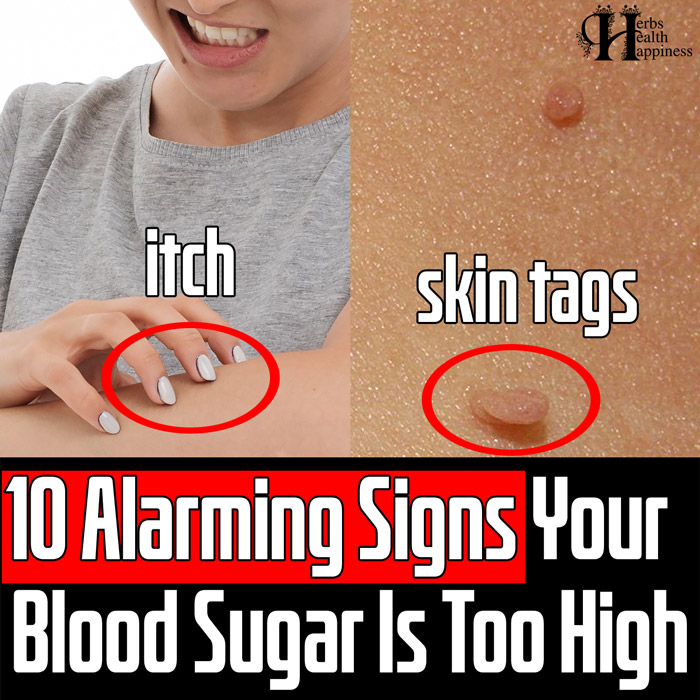 10 Alarming Signs Your Blood Sugar Is Too High