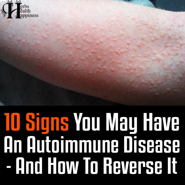 10 Signs You Have an Autoimmune Disease and How to Reverse It