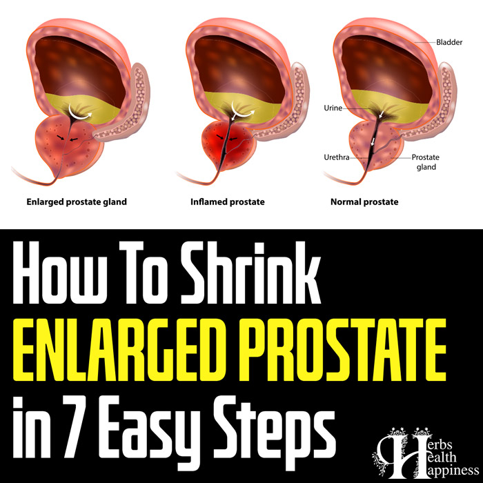 How To Shrink ENLARGED PROSTATE in 7 Easy Steps