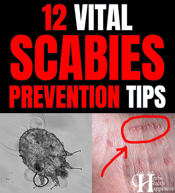 How To Get Rid Of Scabies Plus 12 Prevention Tips